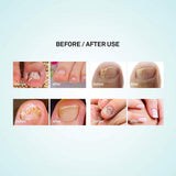 Puriderma Fungus Nail Repair Pen - Fungus Nail Solution, Fungal Nail Eliminator for Fingernails and Toenails