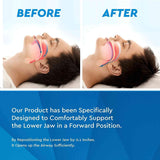 Neomen Snore Stopper-Sleep Aid Device Mouthpiece-Night Guard-Custom Molded Mouthpiece